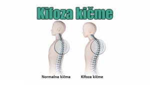 Kifoza kičme – simptomi, uzrok, vežbe i lečenje