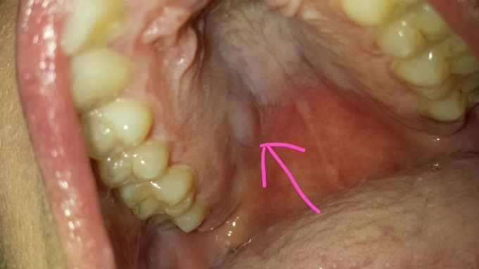 humani papiloma virus u ustima