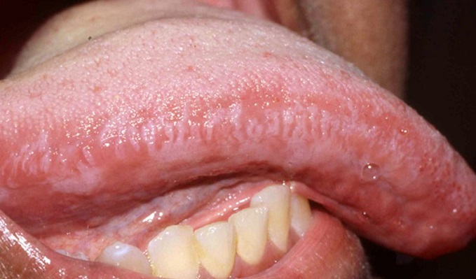 humani papiloma virus u ustima intraductal papilloma and ductal papilloma